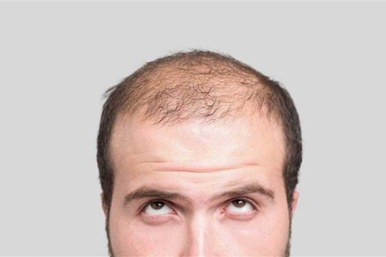 12 Cara Menumbuhkan Rambut Botak dengan Cepat dan Ampuh